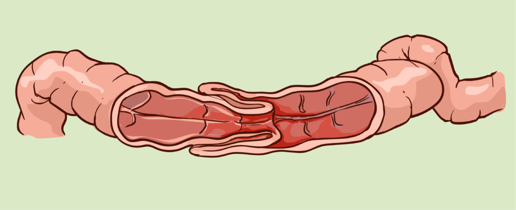 腸重積症の原因