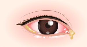 子どもの目が赤くなった 結膜炎の原因とは 小児科オンラインジャーナル