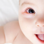 子どもの目が赤くなった〜結膜炎の原因とは？