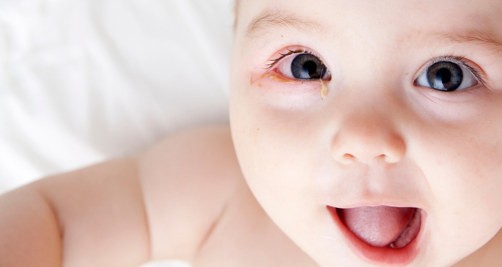 子どもの目が赤くなった 結膜炎の原因とは 小児科オンラインジャーナル