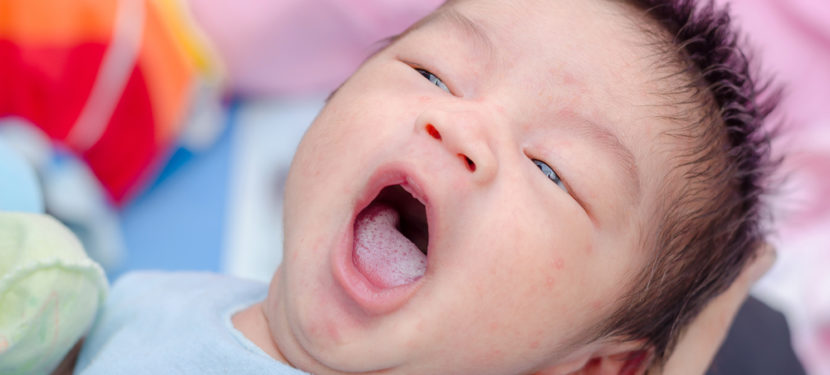 赤ちゃんの舌が白くなる原因の一つ鵞口瘡（がこうそう）とは