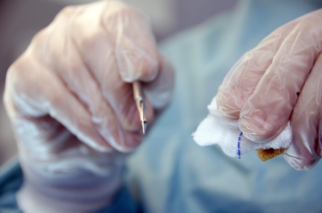 自己免疫性精巣炎にはどのような種類がありますか?